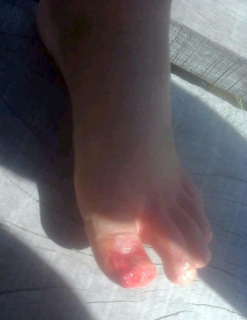 Así le quedó el pie a un pibe atacado por pirañas. Foto: Naineck Prensa Digital.