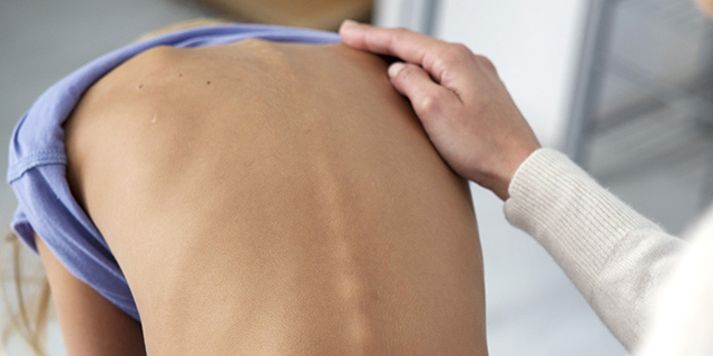 Escoliosis, la adolescencia es clave para descubrirla