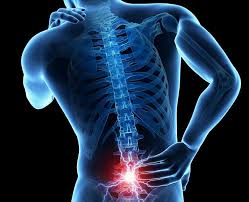 Hernia de disco: los problemas del esfuerzo desmedido.