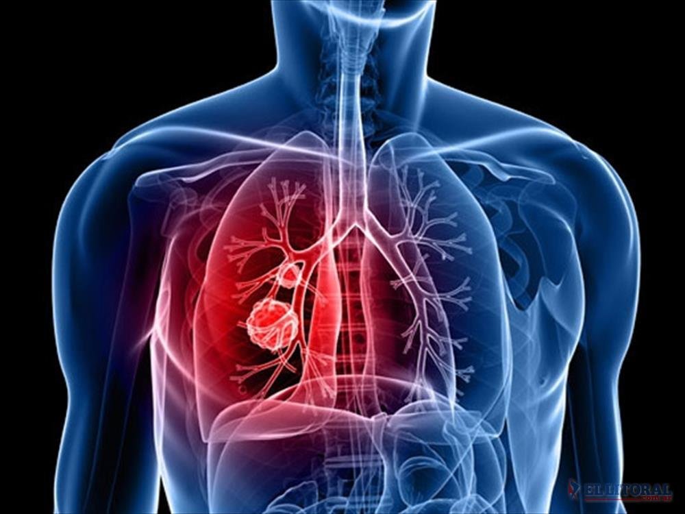 Neumonía: síntomas para estar alerta y consultar al médico