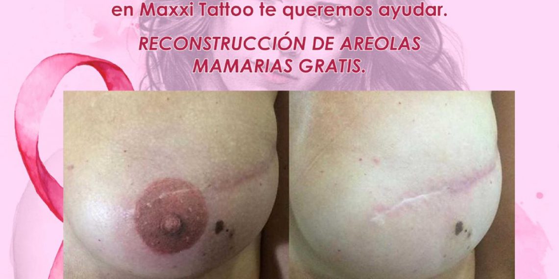 Lanzan un proyecto solidario de reconstrucción de areolas mamarias