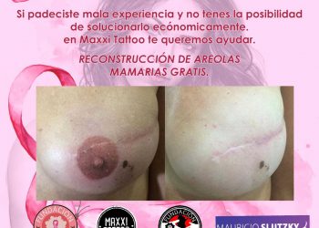 Lanzan un proyecto solidario de reconstrucción de areolas mamarias