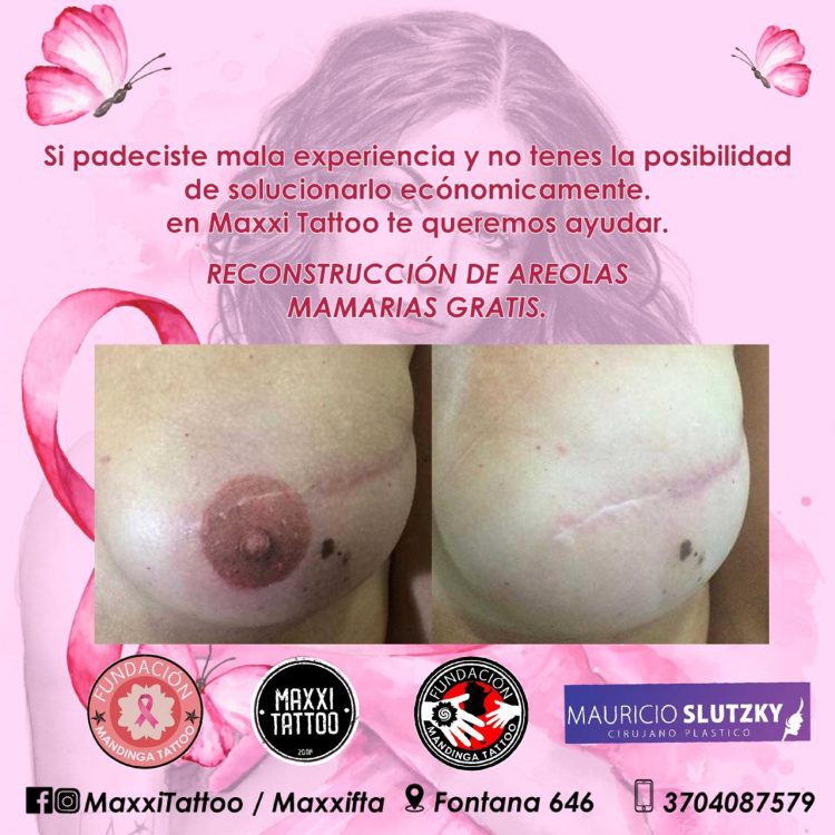 Lanzan un proyecto solidario de reconstrucción de areolas mamarias