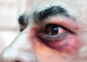 El primer muerto por «hongo negro» en Argentina; detectaron un caso en Formosa