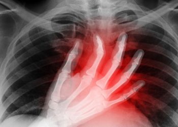 ACV: atención temprana y tratamiento urgente son claves para evitar la discapacidad y la muerte