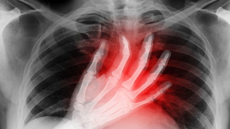 ACV: atención temprana y tratamiento urgente son claves para evitar la discapacidad y la muerte