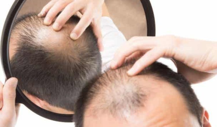 Injerto capilar orgánico