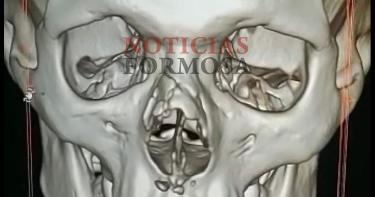 Fiestas violentas: un hombre atacó, al menos, a tres jóvenes «con un palo»