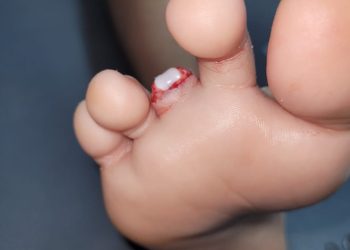 Una piraña «le arrancó un dedo» a un niño «en el banco de arena de Alberdi»