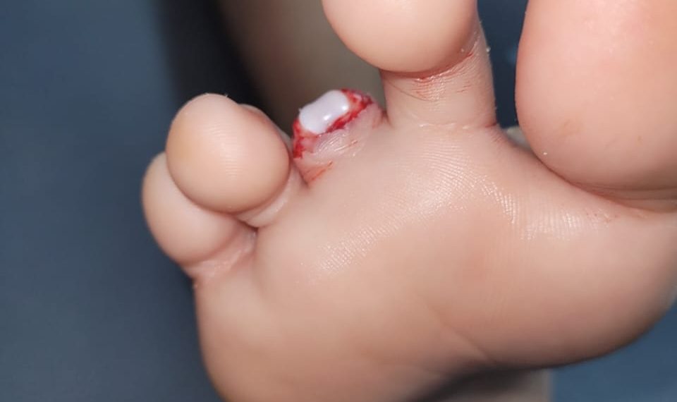 Una piraña «le arrancó un dedo» a un niño «en el banco de arena de Alberdi»