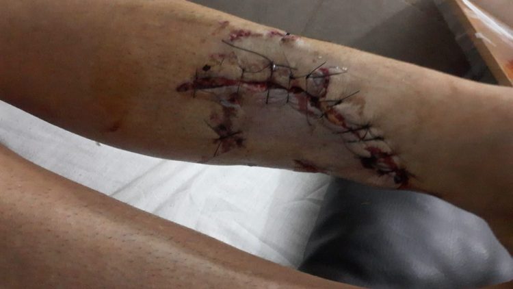 Terrible ataque de un pitbull a una mujer