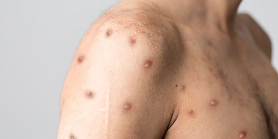 Se detectó la primera persona con viruela del mono en Formosa