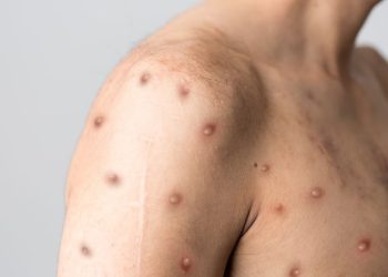 Se detectó la primera persona con viruela del mono en Formosa