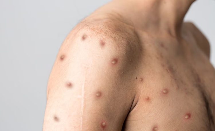 Se detectó la primera persona con viruela del mono en Formosa