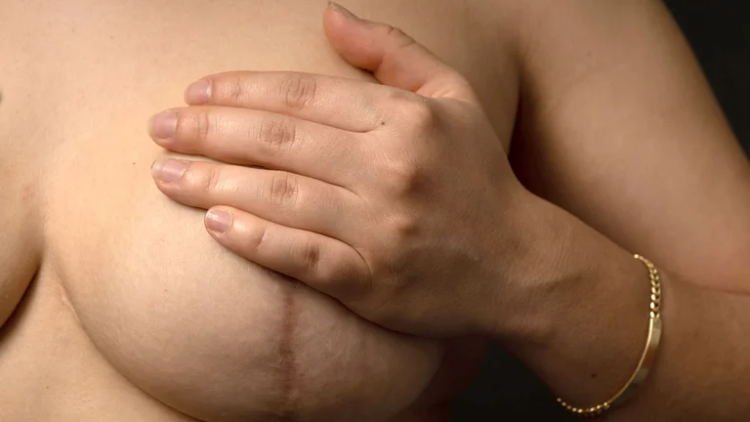 Crecimiento exponencial del cáncer: por qué subieron los casos un 80% en menores de 50 años