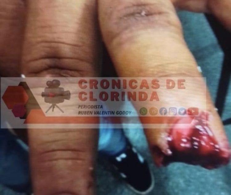 Le arrancó el dedo de un mordisco: el hombre detenido por incidentes en una fiesta, fue denunciado por lesiones gravísimas