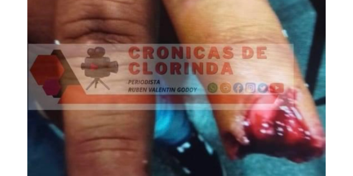 Le arrancó el dedo de un mordisco: el hombre detenido por incidentes en una fiesta, fue denunciado por lesiones gravísimas