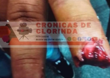 Le arrancó el dedo de un mordisco: el hombre detenido por incidentes en una fiesta, fue denunciado por lesiones gravísimas