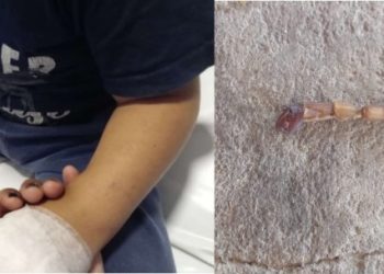 Niño de 3 años fue picado por un alacrán en una colonia de Naineck