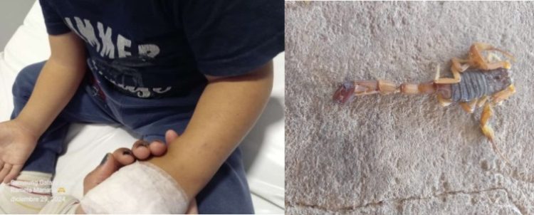 Niño de 3 años fue picado por un alacrán en una colonia de Naineck