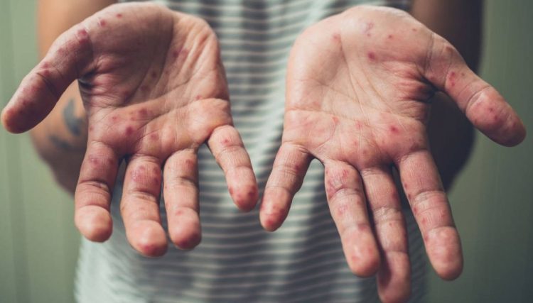 Medidas preventivas contra el sarampión: todo lo que tenés que saber, en medio del brote en el país