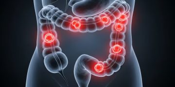 Científicos argentinos desarrollaron un virus que ataca el cáncer colorrectal y sus células resistentes