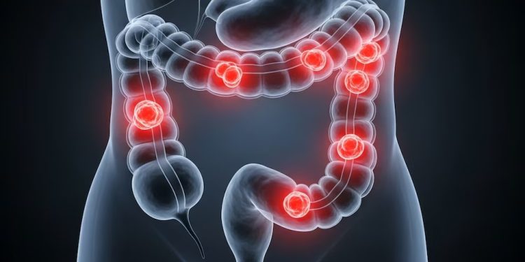 Científicos argentinos desarrollaron un virus que ataca el cáncer colorrectal y sus células resistentes