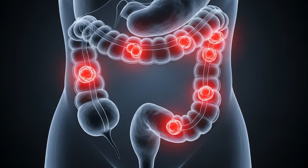 Científicos argentinos desarrollaron un virus que ataca el cáncer colorrectal y sus células resistentes