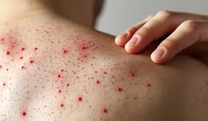 Salud alerta sobre la circulación de cuatro viajeros con sarampión por varias provincias del país