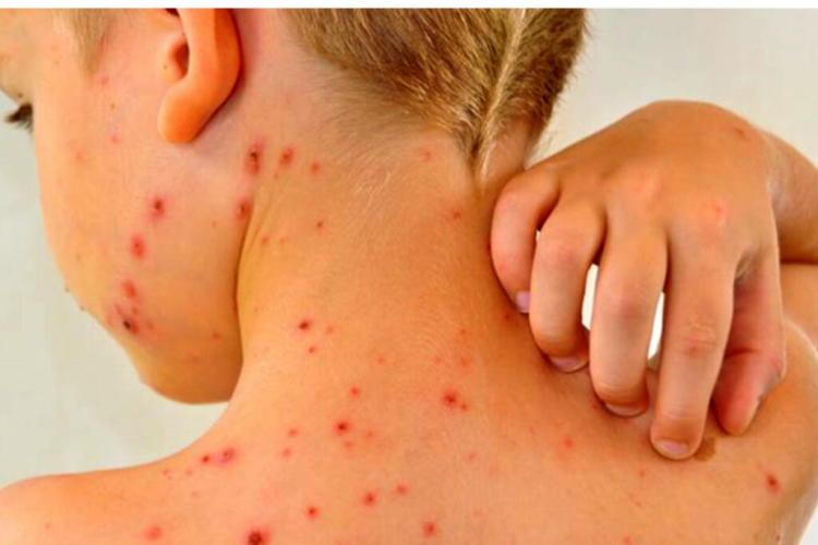 Formosa contra el sarampión: Reiteraron la importancia de tener al día la vacunación