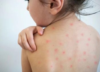 Un caso de sarampión en Entre Ríos reactivó la alerta sanitaria nacional: los detalles del paciente y cómo se encuentra
