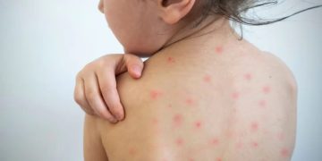 Un caso de sarampión en Entre Ríos reactivó la alerta sanitaria nacional: los detalles del paciente y cómo se encuentra